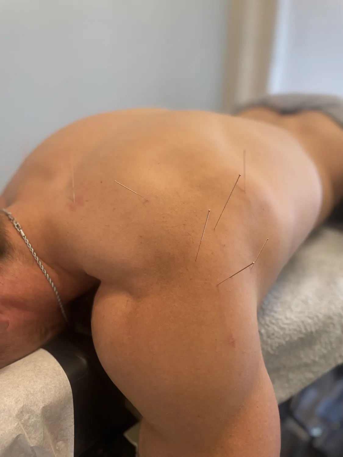 Dry needling used as part of a chiropractic consultation
